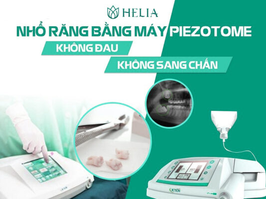 Chỉ 15 phút nhổ răng khôn bằng máy Piezotome